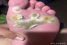 跖疣没有黑点只有白芯